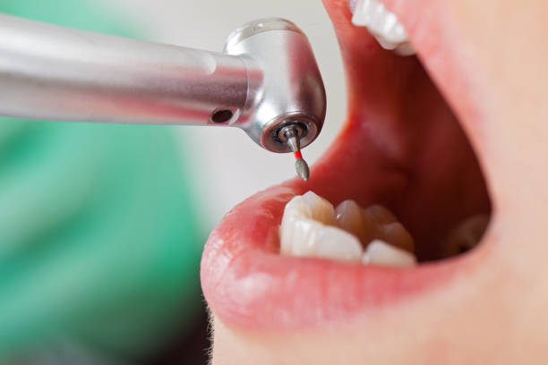 Best Emergency Wisdom Teeth Removal in Warrenton, MO